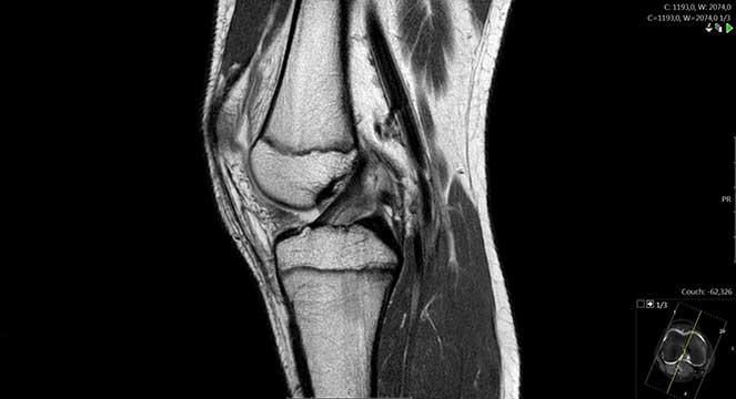 3 exames para fazer o diagnóstico da lesão do ligamento cruzado