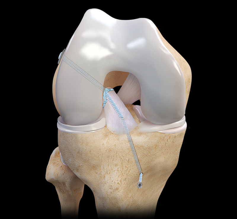 Por que o ligamento não se regenera?